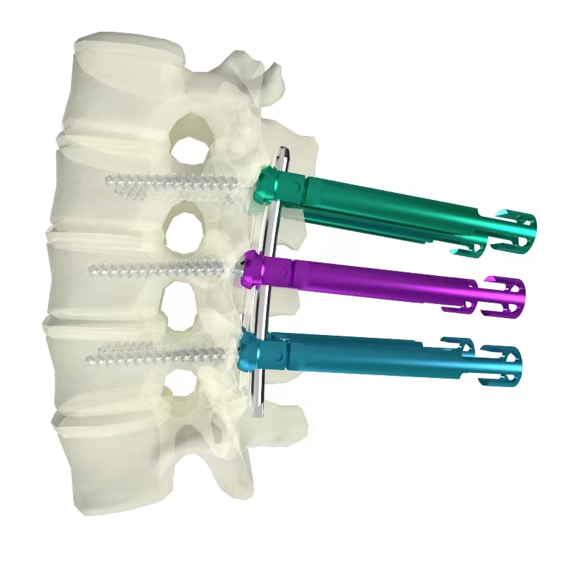 胸腰椎后路內固定系統